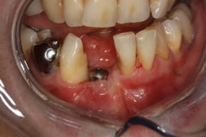 Mise en fonction apr s d pose des sutures un6vqx - Eugenol