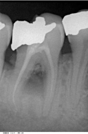 Necrose 2 qdo6ij - Eugenol