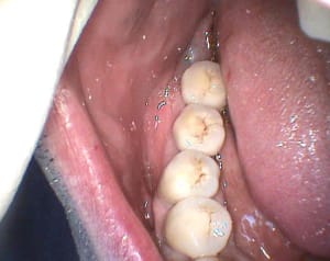 Occlusale xbb0ar - Eugenol