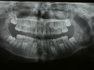Odontome 1 anvgrl - Eugenol