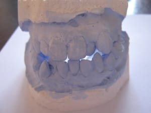 Orthodontie hanguag siham debut de traitement 003 dmi3q4 - Eugenol