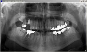 Pano post op maugof - Eugenol