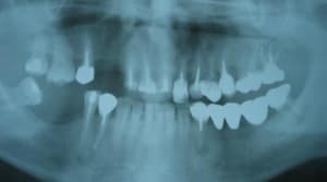 Pano implant pre op b1hiek - Eugenol