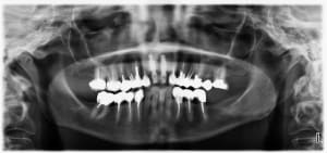 Pano post op j5bozd - Eugenol