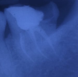 Post endo g2bogf - Eugenol