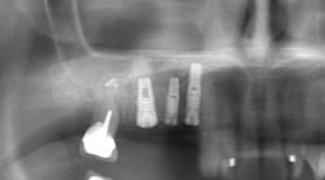 Post op summers sqmlbd - Eugenol