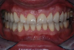 Post op wpn8np - Eugenol