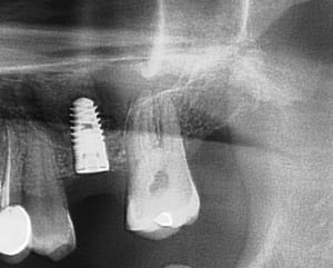 Post op yvasmq - Eugenol