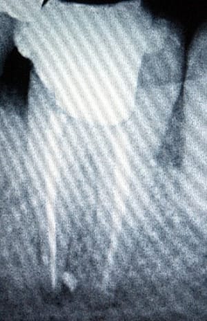 Postop36 ykikvu - Eugenol