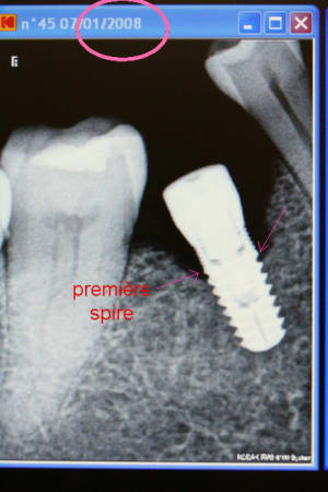 Premi re spire oyhp4a - Eugenol