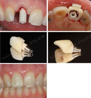 Provisoire implanto odlvja - Eugenol