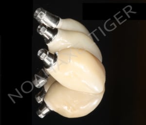 Provisoires implantoport s ufbbpw - Eugenol