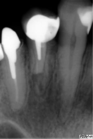 Resorption 2 au0ps0 - Eugenol