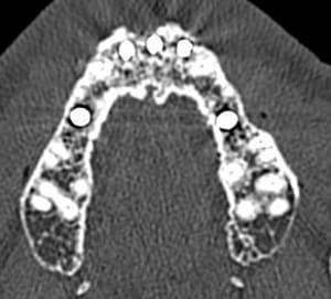 Scanner implant 12 vi fcrlqy - Eugenol