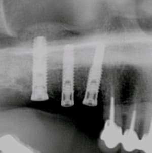 Sinus lift et pose zxhz3h - Eugenol