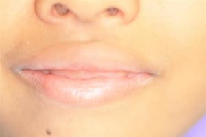 Sourire gingival   6 ans 005  medium  easjlf - Eugenol