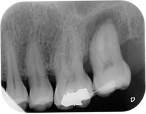 Splint ktzbwp - Eugenol