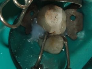 Strat dentine kjbnme - Eugenol