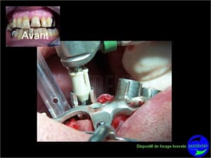 Suite eimci   positdental 011 danzy7 - Eugenol