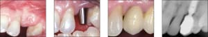 Surgical 2s oyzkyp - Eugenol