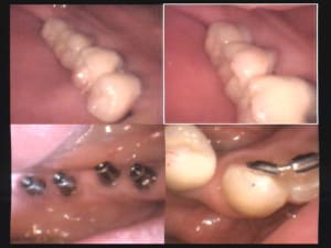 Un cas difficile essai bridge sur implant bas droit 2 acm7c4 - Eugenol