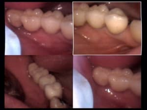 Un cas difficile essai bridge sur implant bas droit i60vng - Eugenol