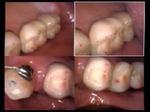 Un cas difficile essai bridge sur implants haut droit vn52nc - Eugenol