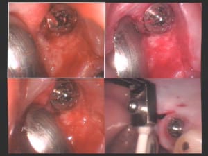 Un cas difficile réouverture implants 16 et 17   ii pld3ho - Eugenol