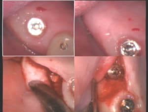 Un cas difficile réouverture implants 16 et 17   i zcjqkf - Eugenol