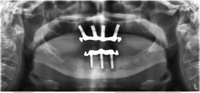 001 xtiog5 - Eugenol