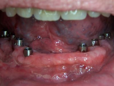01positdental  003 c7vzaz - Eugenol
