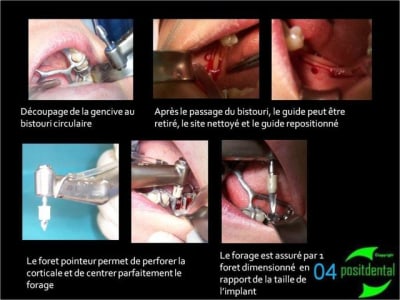 04 positdental guide chirurgical juxta muqueux   appuis dentaires fhl6lm - Eugenol