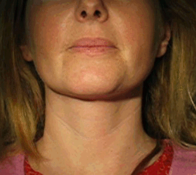 09 pre traitement pdtkvx - Eugenol