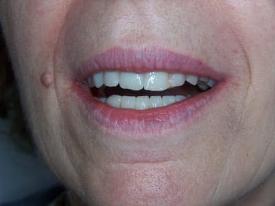 11 04 11 positdental 014 hqftge - Eugenol