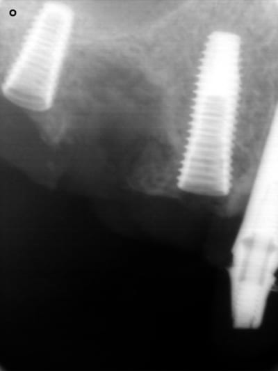 14 implant dentium 24 02 09 jec4bx - Eugenol