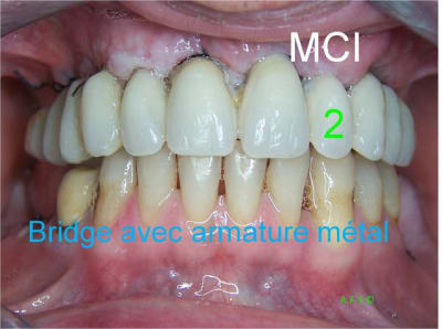 1 2 3 mci 004 mv3fou - Eugenol