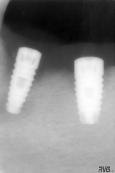 1 implant 02 07 nxo7lr - Eugenol