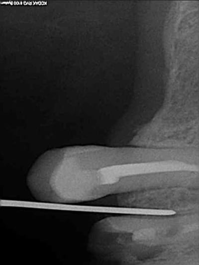 1 periotome q3dcej - Eugenol