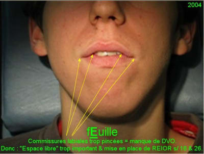 2004 feuille comiss labiales ibmgbp - Eugenol