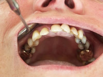 2010 mci  positdental 004 iuoumk - Eugenol