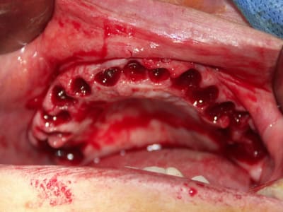 2010 mci   positdental yhem4k - Eugenol