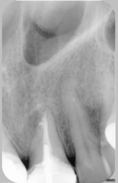 21 postop pomtkz - Eugenol