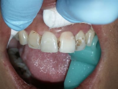 2e seance apres gel iq4jwv - Eugenol