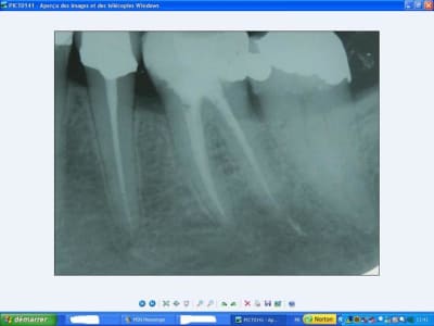 36postop tmfern - Eugenol