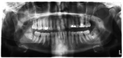 38 cariee etynjg - Eugenol