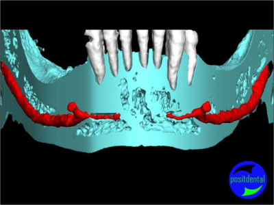 4 positdental mod lisation 3d ynorkb - Eugenol