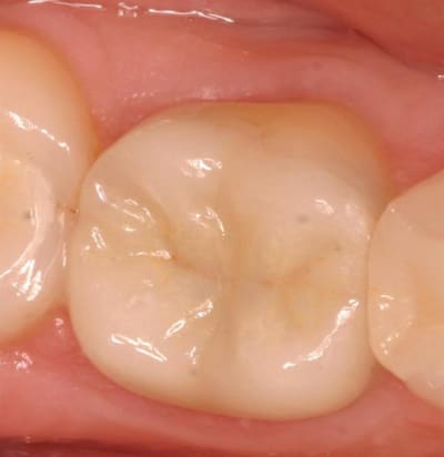 46 14 y.o - Eugenol