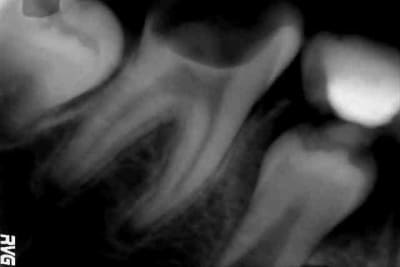 46 apr s curetage kaffcz - Eugenol