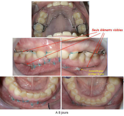 4 canines 8jours ewocp6 - Eugenol