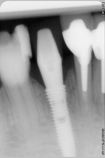 4 mois post op vccpeu - Eugenol